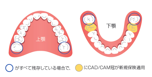 大臼歯CAD/CAM冠の算定条件
